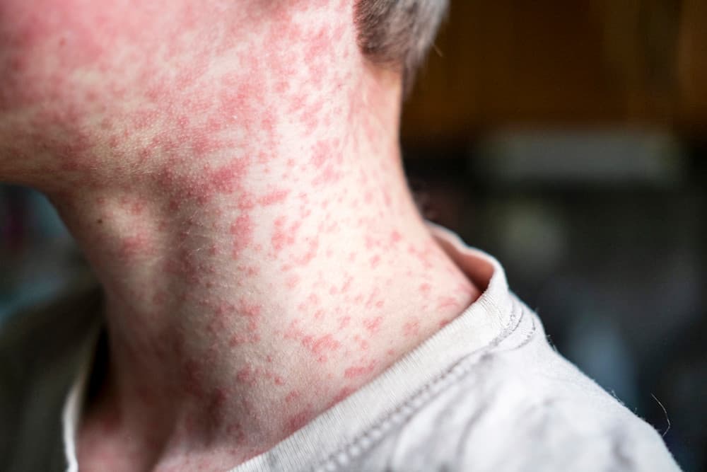 Measles viral disease