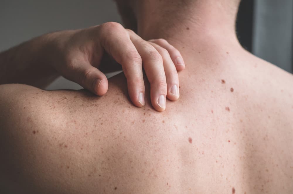 Close up photo of skin moles