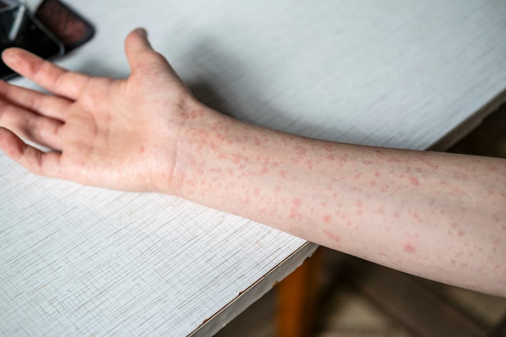 A teenager's hands covered in a measles rash